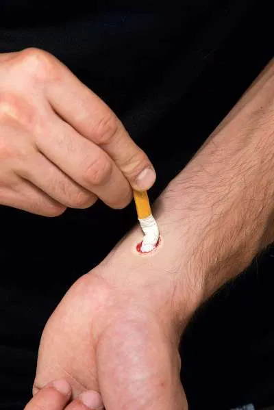 Cigarette Burn
