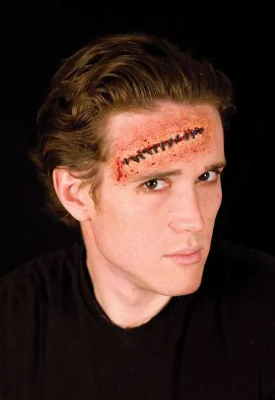 Stitches